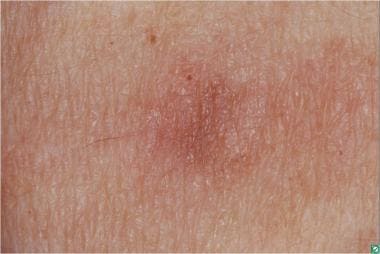 A featureless reddish brown plaque on the arm of a