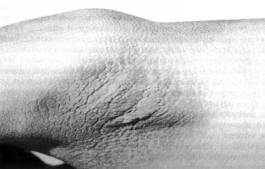 Acanthosis nigricans of the axillary fossa in Crou