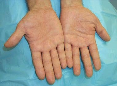 Dyshidrotic eczema (pompholyx). Multiple tense ves