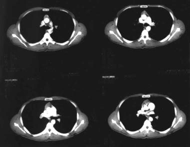 CT scan of chest showing an anterior mediastinal m