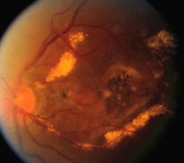 Late complication of choroidal neovascularization 