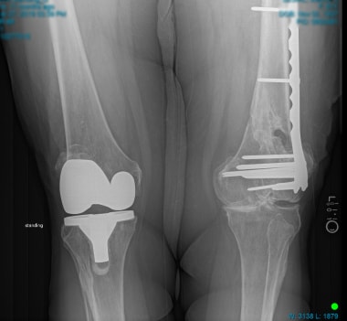 Nonunion of distal femur periprosthetic fracture a
