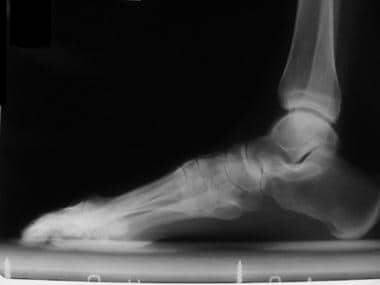 Lateral radiograph of foot shows idiopathic hallux