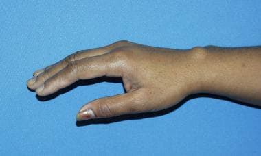 Typical appearance of dorsal ganglion cyst. 