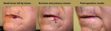 Left: Small lower left lip lesion. Center: Excisio