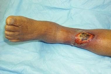 St Louis Chronic Venous Insufficiency Treatment