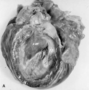 Myocardial as well as valvular involvement with Lo