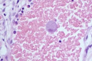 Giant cell with inclusion body characteristic of c