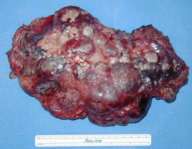 Fatal liver cyst rupture in polycystic liver disease complicated