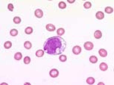 Blood film (1000× magnification) demonstrating a v