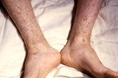 Petechiae on lower extremities. Courtesy of Profes