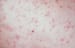 Cutibacterium (Propionibacterium) Infections