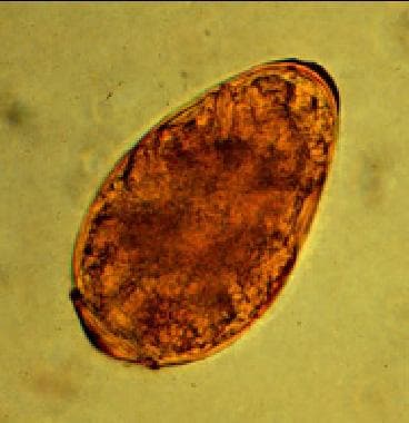 Trematode Infection: Background, Pathophysiology, Epidemiology