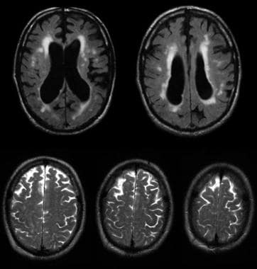 severe hydrocephalus mri