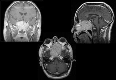 Esthesioneuroblastoma. A 39-year-old man presented