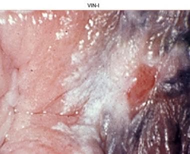 Vulvar intraepithelial neoplasia, grade I (VIN I).