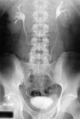 Intravenous urogram in a patient with retroperiton