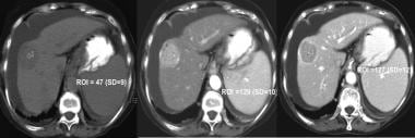 Triple-phase CT scan of liver cancer, revealing cl