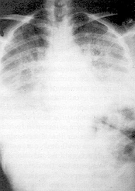 phosgene gas effects