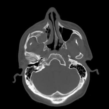 zygomatic arch fracture symptoms