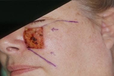 Large medial cheek defect. Reconstruction with a c