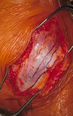 Iliac crest tissue transfer. Exposure of the exter