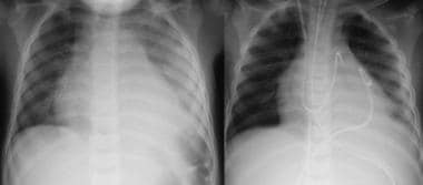 Left: Chest radiograph in a patient with bacterial