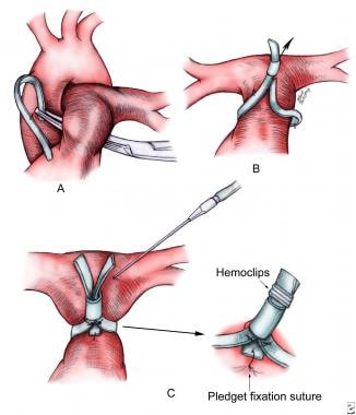 Pulmonary artery banding technique (A-C) using a p