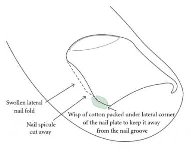 Schematic view for cotton wick insertion. Courtesy