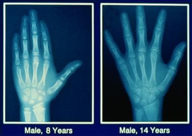Bone age comparison between an 8-year-old boy (lef