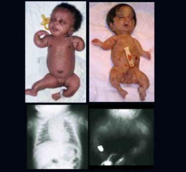 Two infants with perinatal lethal form of osteogen