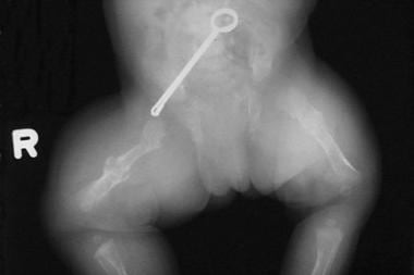 This newborn has bilateral femoral fractures. 