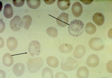 A blood smear of a patient with beta thalassemia t