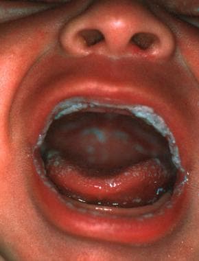 anorectal candidiasis