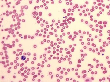 Peripheral blood smear in hemolytic-uremic syndrom