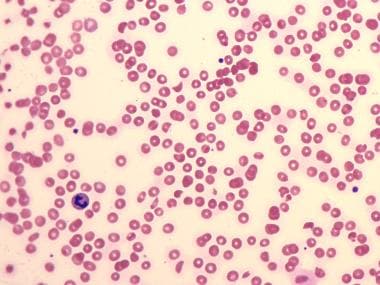 thrombotic thrombocytopenic purpura histology