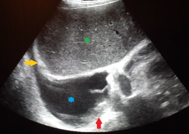 This ultrasound image of the right lower chest dem