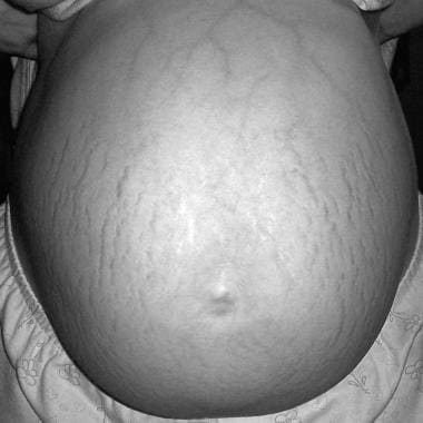 20 Weeks Pregnant  Stretch Marks, Ultrasound And Infections