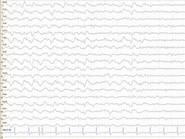Frontal intermittent rhythmic delta activity (FIRD
