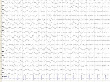 What Eeg Findings Are Characteristic Of Progressive Supranuclear Palsy Psp