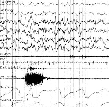 eeg sleep study