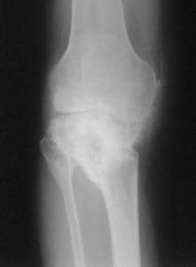 Total knee arthroplasty. Radiograph demonstrating