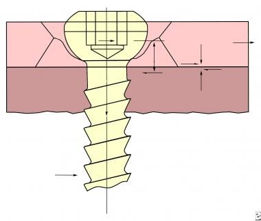 Conventional plate screws. 