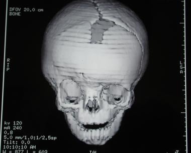 Craniosynostosis management. Preoperative CT image