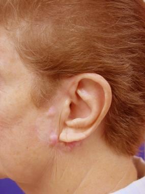 A patient referred for keloid formation after exci