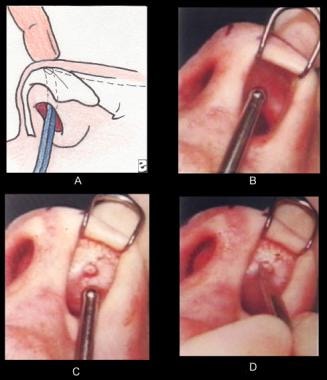 (A-B) The suction tip is placed intranasally in th
