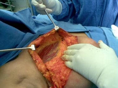 Raised superior flap, with breast being dissected 