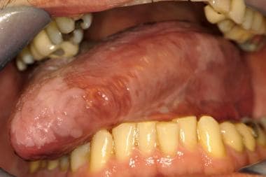 speckled leukoplakia