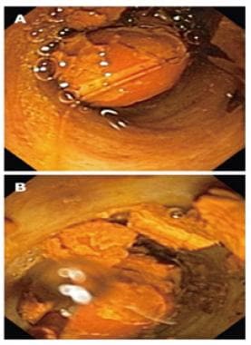 Cholangioscopic view of (A) bile duct stone and (B
