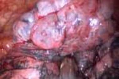Surgical field showing bullae. Image courtesy of R